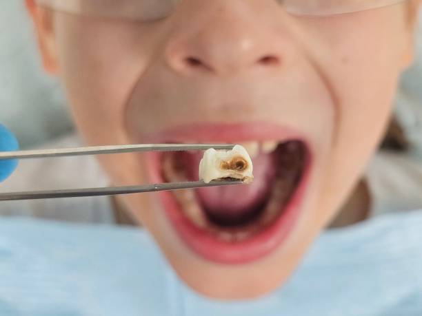 Best Dentist for Tooth Abscess  in Magalia, CA